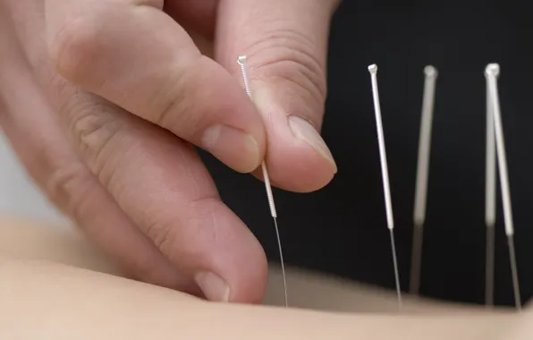 Picture hands, skin, fingers, needles, acupuncture